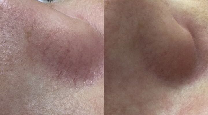 laserowe-zamykanie-naczynek-derma-academy-02