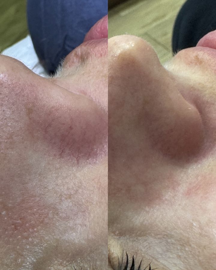 laserowe-zamykanie-naczynek-derma-academy-02